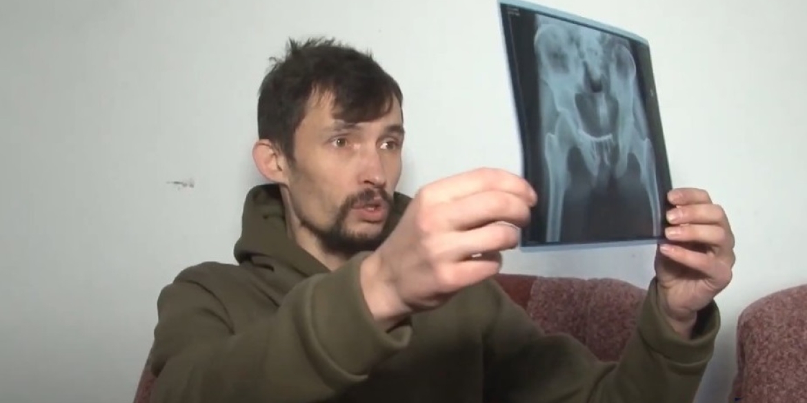 У Вінниці поставили перші імпланти для остеосинтезу постраждалим через війну
