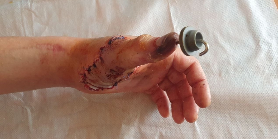 Вінницькі лікарі пришили чоловікові палець, який він привіз у банці