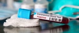 Минулої доби на COVID-19 захворіли 17 мешканців Вінницької області