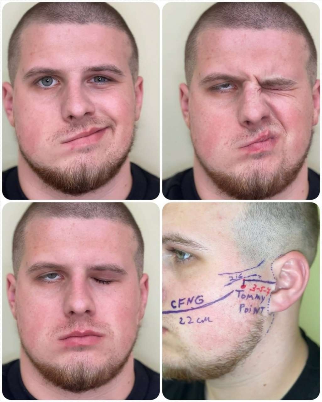 Вперше у Вінниці: лікарі «Пироговки» повертають посмішку воїну через унікальну надскладну операцію