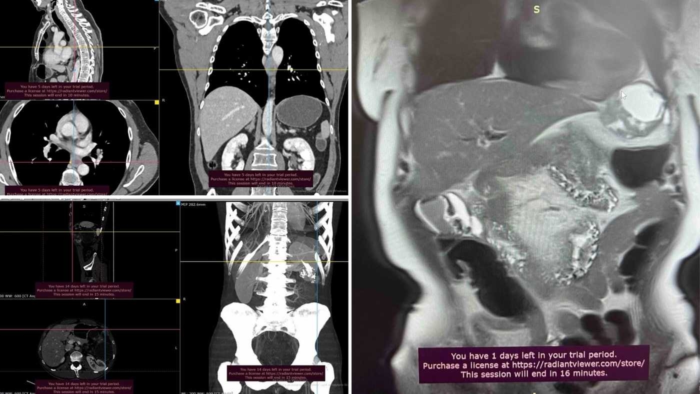 Складна онкохірургія: у Вінниці оперували три рідкісні випадки за один тиждень