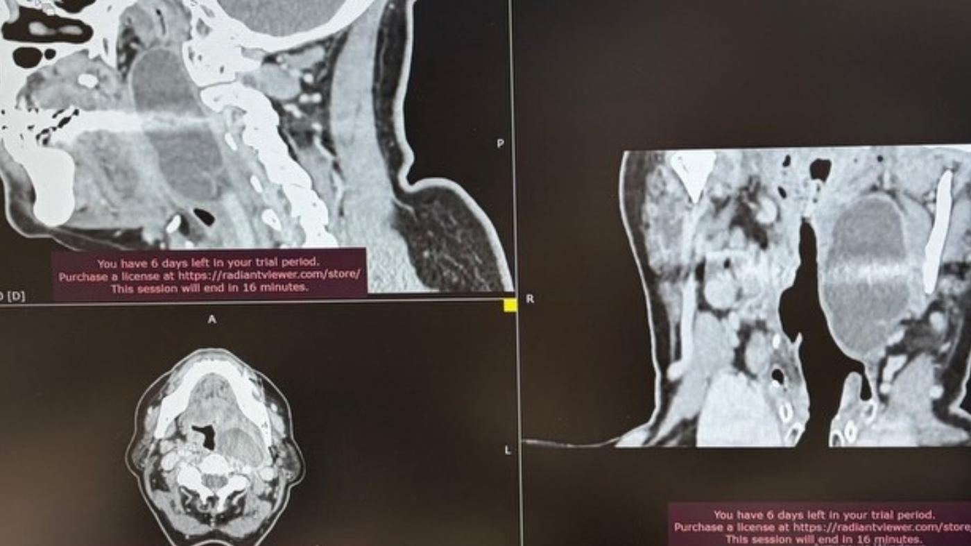 Заважала їсти й дихати: вінницькі лікарі успішно видалили рідкісну пухлину шиї