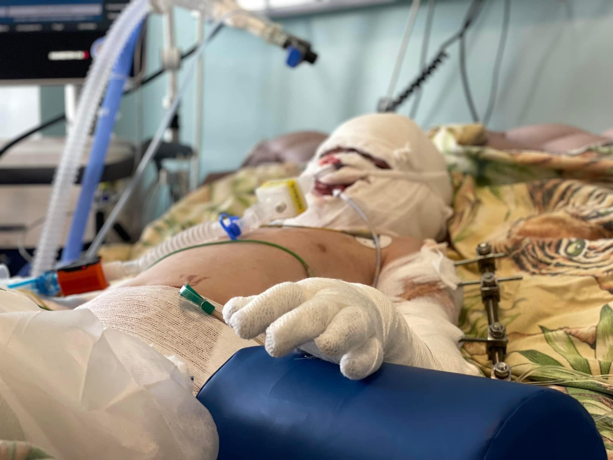Семирічного хлопчика, який постраждав під час обстрілу Вінниці, лікують в Німеччині