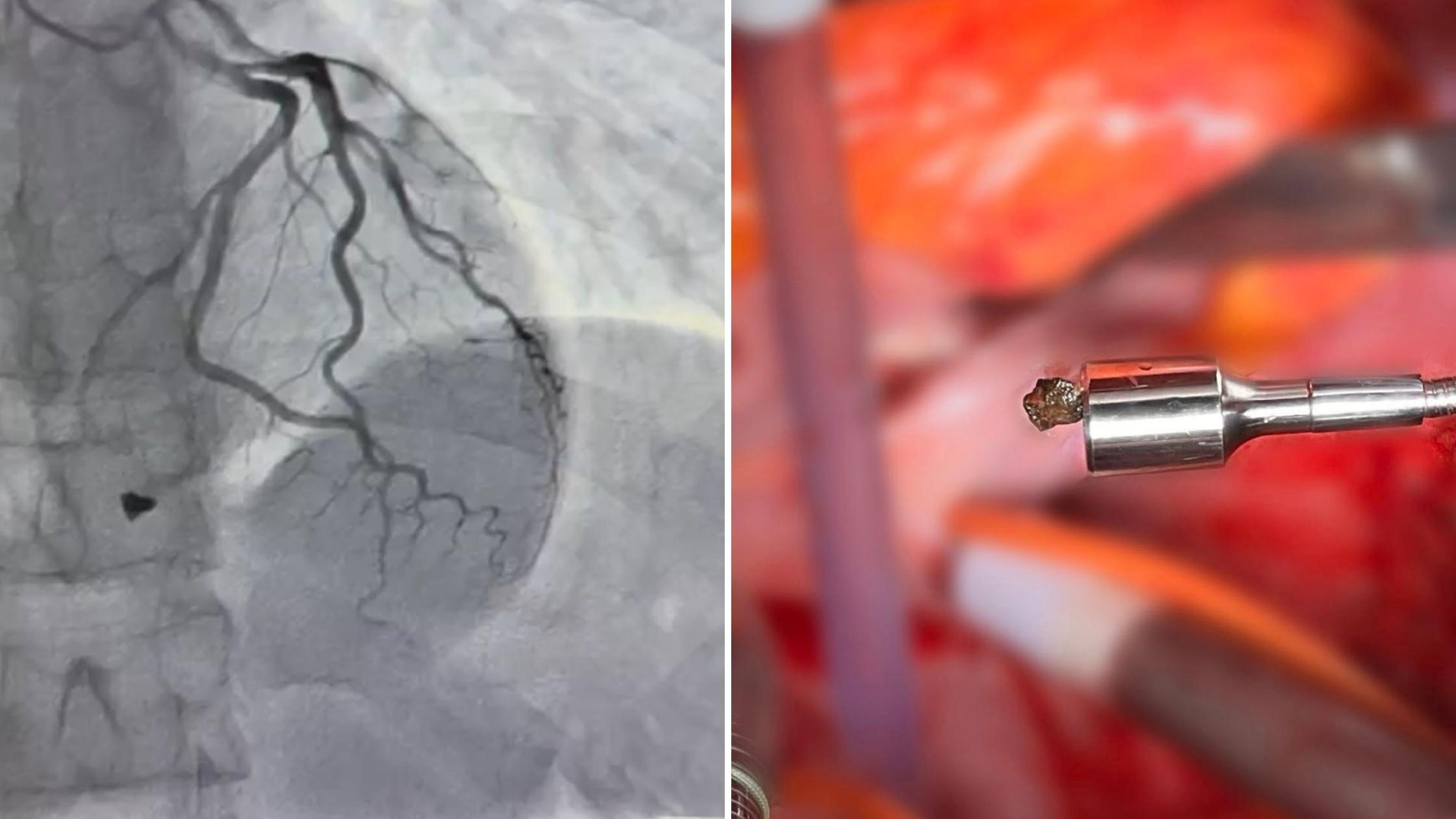 Уламок зупинився у ділянці серця: вінницькі медики врятували життя пораненого