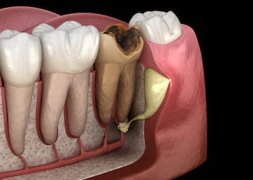 Методи полоскання рота для виведення гною з зуба