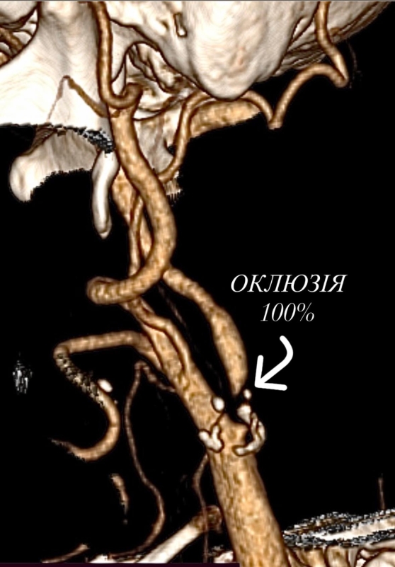 Вінницькі лікарі успішно виконали складну операцію на сонній артерії