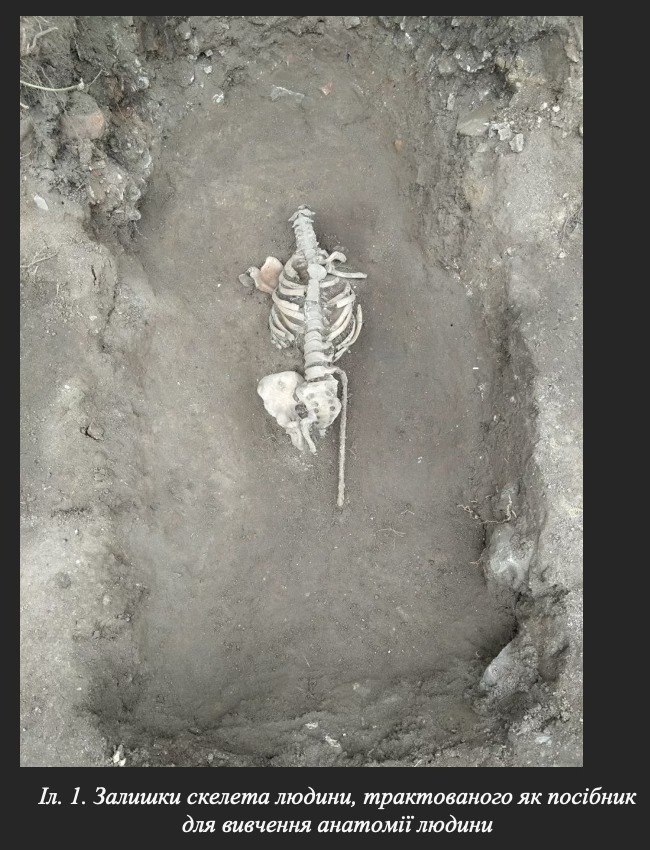 У Вінниці археологи зробили унікальну знахідку: стародавній череп зі слідами трепанації