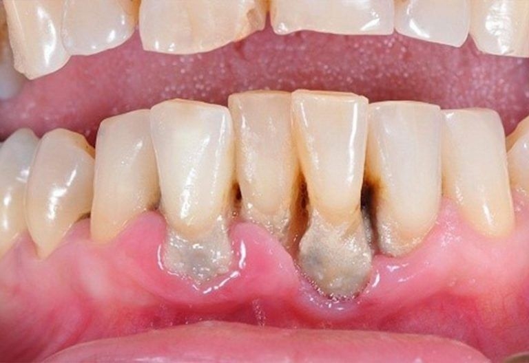 Зубний нарив або гнійник на яснах - що це таке?