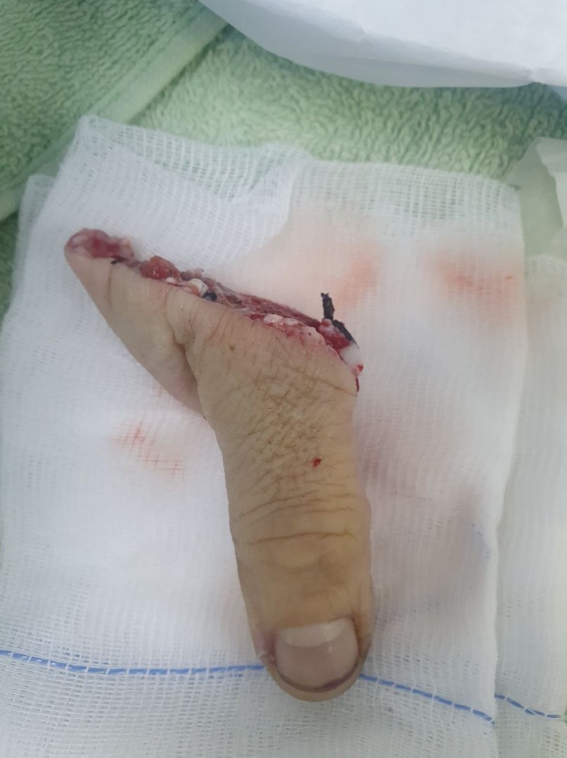 Вінницькі лікарі пришили чоловікові палець, який він привіз у банці