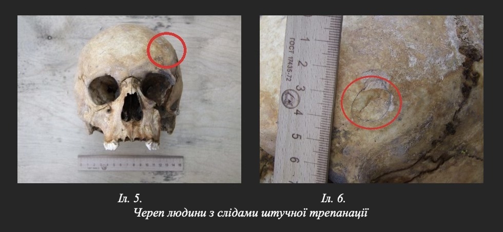 У Вінниці археологи зробили унікальну знахідку стародавній череп зі слідами трепанації